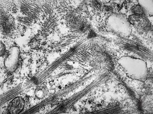 M,47y. | hypertrophic cardiomyopathy - left ventricle-crossing of myofilaments can also be caused arteficially with bioptom M,47y. | hypertrophic cardiomyopathy - left ventricle-crossing of myofilaments can also be caused arteficially with bioptom